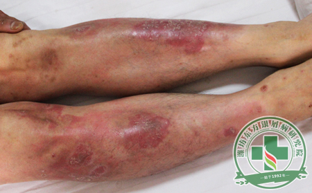 已产生心理问题的牛皮癣患者应该怎么办