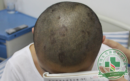 要护理头部牛皮癣患者可以从学会按摩开始
