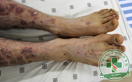 脓疱型牛皮癣引发后的病症表现是怎样