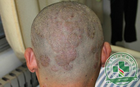 济南男性牛皮癣患者病症复发