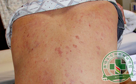 银屑病反复发作济南患者该怎么办