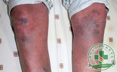 济南牛皮癣患者都去哪家医院治疗