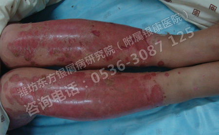 济南银屑病治疗专科医院哪家可以