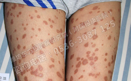 济南牛皮癣患者怎么治疗可以得快