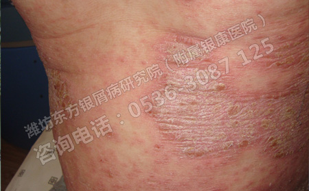 济南冬天银屑病患者的预防重点