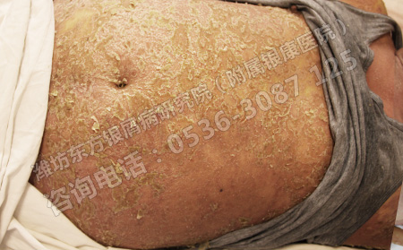 济南银屑病患者病情恶化的症状是什么