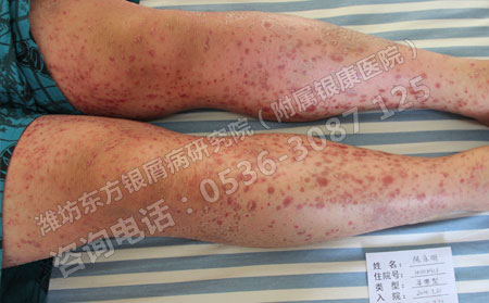 济南治疗牛皮癣效果可以的医院