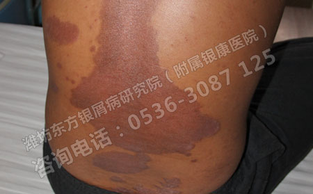 为什么济南牛皮癣患者要选择专业医院