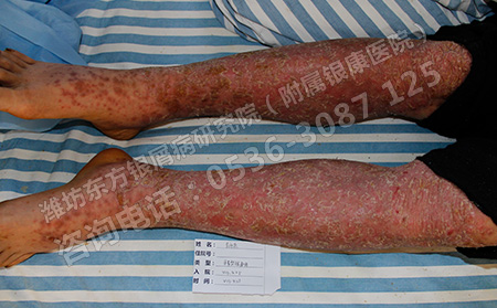 济南牛皮癣治疗的可以方法介绍