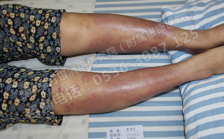 济南牛皮癣治疗非常可以的医院是哪家