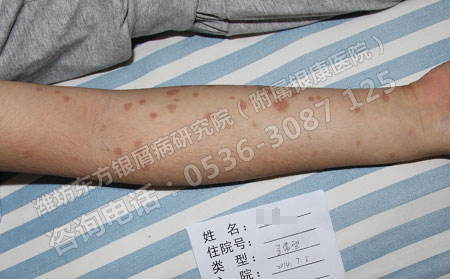 预防银屑病有哪些可以方法