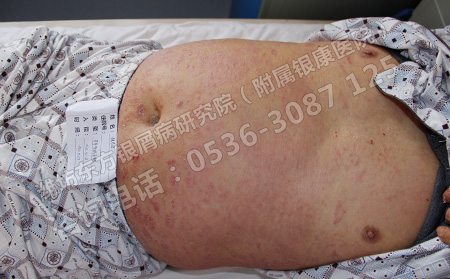 济南银屑病患者病情加重的原因有哪些