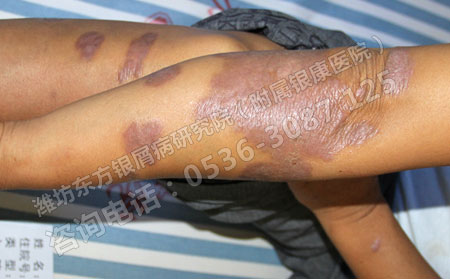 济南关节牛皮癣患者如何保护关节