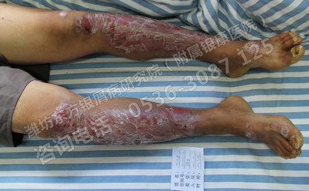 济南银屑病患者腿上脱屑怎样治疗