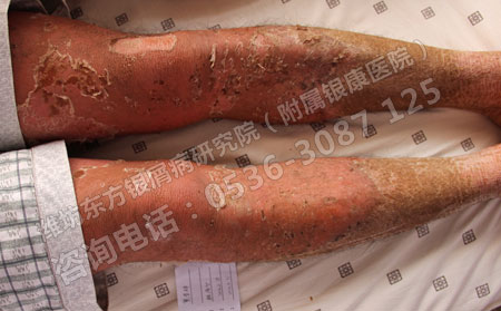 济南银屑病治治疗效果果不理想的原因