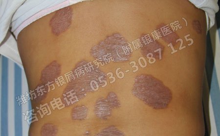 银屑病,银屑病危害,银屑病症状