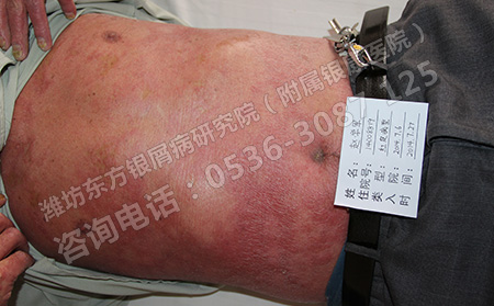 济南牛皮癣病情加重的原因有哪些