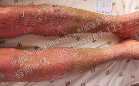 济南的银屑病医院治疗的优势是什么