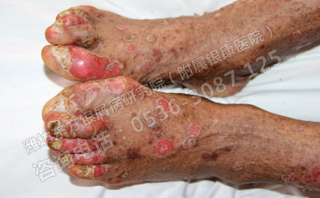 患上银屑病该怎么办呢