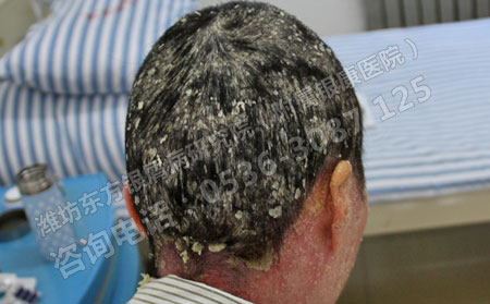 济南银屑病患者要了解的银屑病常识