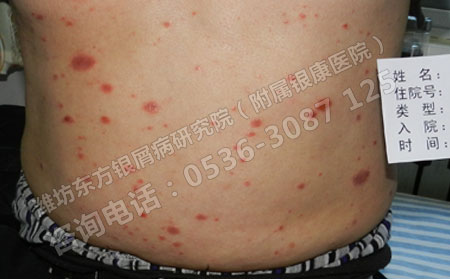 春季怎么护理银屑病效果可以