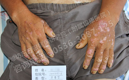 手部牛皮癣,牛皮癣治疗,脸部牛皮癣