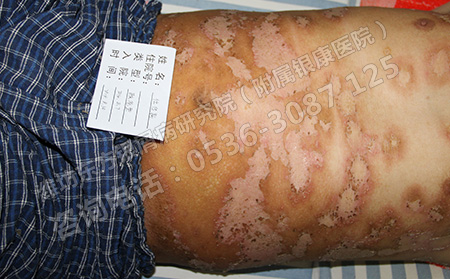 银屑病总是反复怎么办