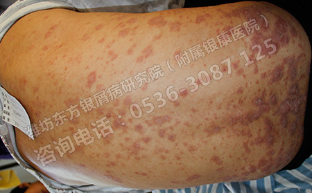 济南预防牛皮癣复发的措施介绍