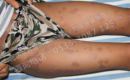 山东济南银屑病医院讲银屑病生活病因