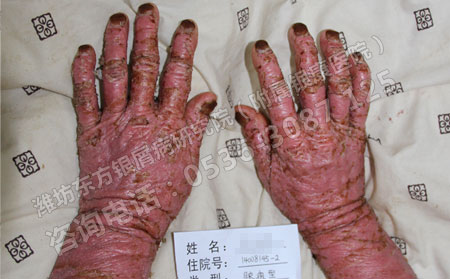 济南银屑病患者治疗之前要做哪些检查