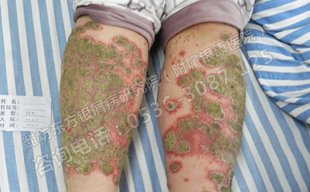 济南银屑病医院：脓疱型银屑病危害知多少