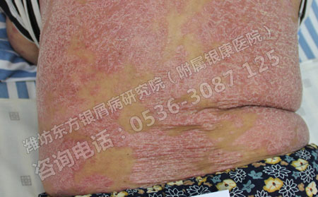 济南银屑病患者怎样可以快速治可以银屑病