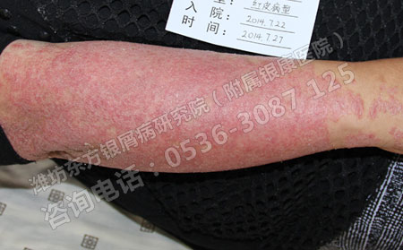 济南银屑病加重要怎样治疗