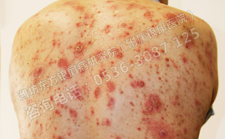 怎么克服牛皮癣临床治疗中面临的难题