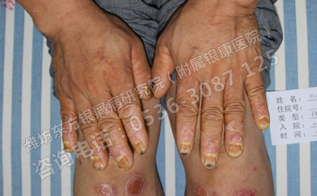 济南银屑病医院提醒春季预防银屑病复发