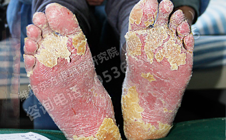 如何治疗牛皮癣治疗效果持久不容易反复发作