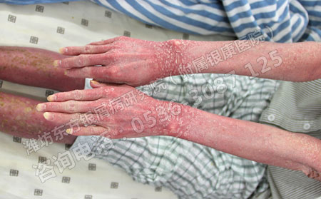 济南银屑病患者病情总是治不可以的原因是什么