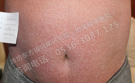 银屑病患者生活中要当心哪些诱因
