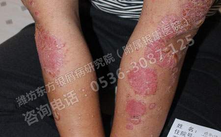 济南银屑病患者如何进行春季护理