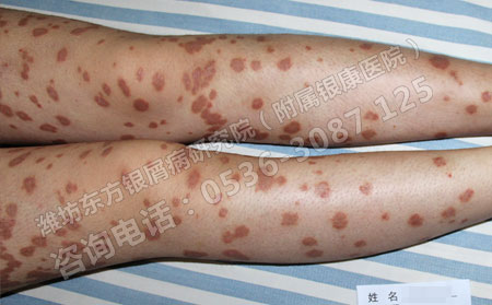 济南银屑病患者该如何预防春季银屑病的发生