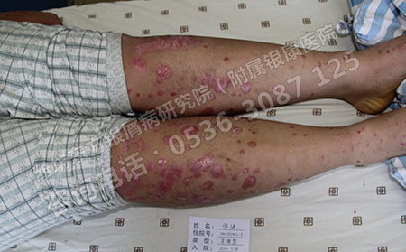 银屑病患者要根据发病部位合理使用外用药