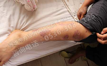 临床治疗牛皮癣有什么可以的方法呢