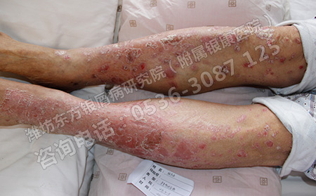 有心理压力会对银屑病病情产生影响吗