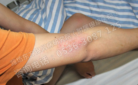 治可以银屑病怎样科学用药呢