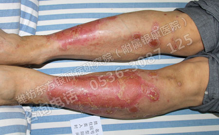 银屑病患者春季要禁忌哪些不利因素