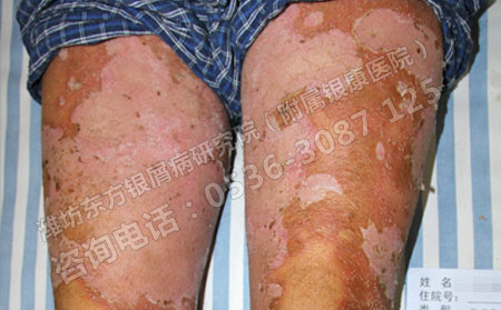 肥胖，银屑病发病的因素之一