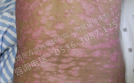 过度饮酒真的会诱发银屑病吗？