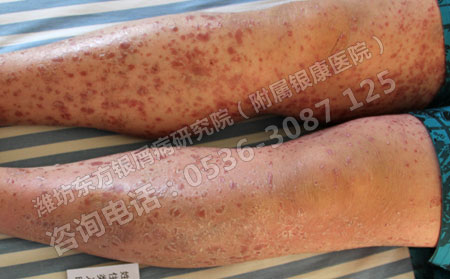 维生素Ｃ可以改善银屑病吗？