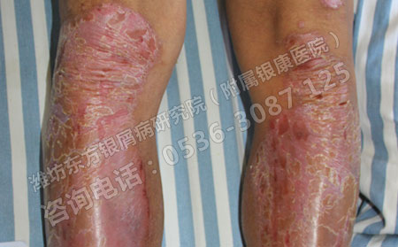 吸烟真的会引发银屑病吗？