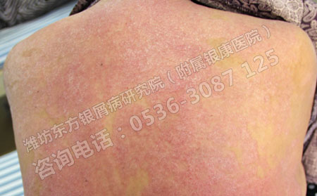 寻常型银屑病会扩散到全身吗